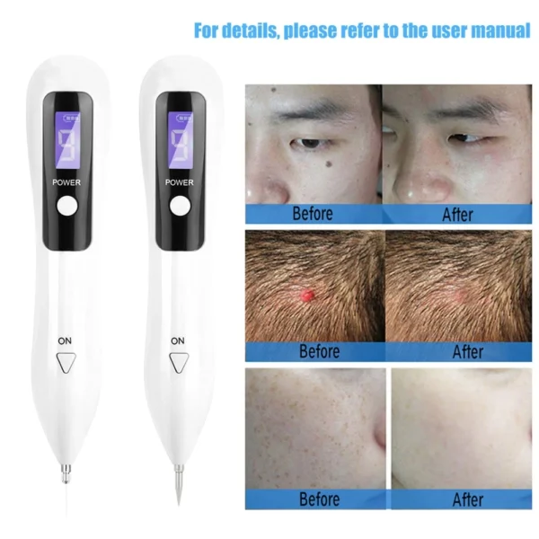Spot Removal Machine Portable LCD Dot Mole Freckle Spot Tattoo Removal Pen Beauty Skin Machine Freckle Removal Machine - Image 3